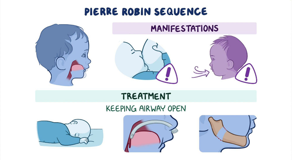 Pierre Robin sequence