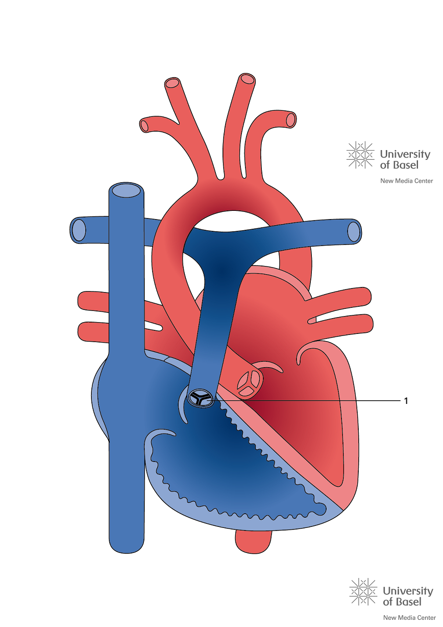 Pulmonalisklepstenose