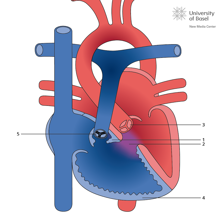 TOF: Tetralogie van Fallot