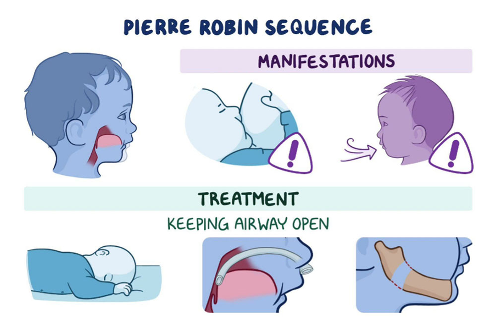 Pierre Robin sequence