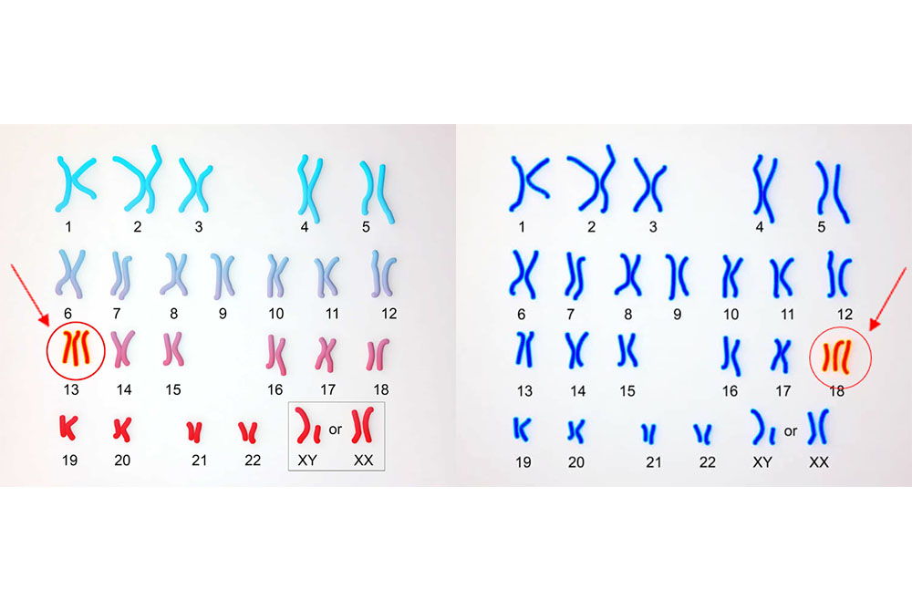 Trisomy 13 en 18