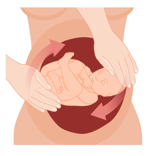 We kunnen de baby proberen te draaien met de handen. Aan de buitenkant van de buik duwen we met de handen op de billen en het hoofd. De billen duwen we omhoog, het hoofd naar beneden.
