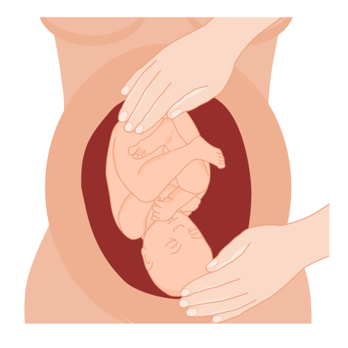 We duwen totdat de baby gedraaid is en met het hoofd naar beneden ligt.