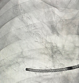 Apreo-implantaten